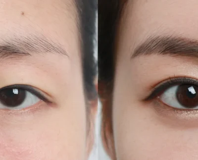 upper eyelid surgery blepharoplasty