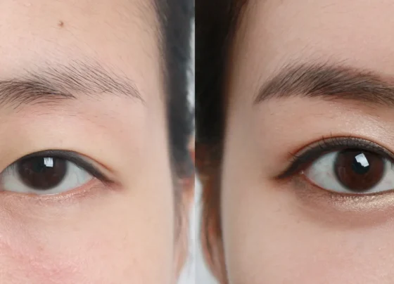 upper eyelid surgery blepharoplasty