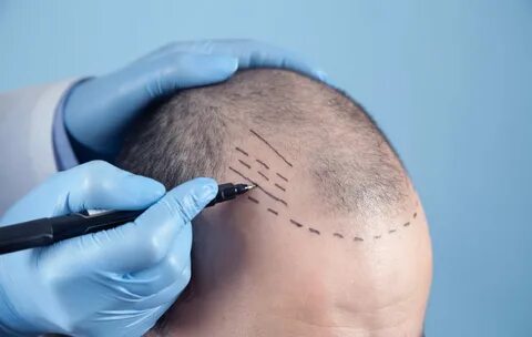 A Comprehensive Guide to Hair Transplant in Islamabad