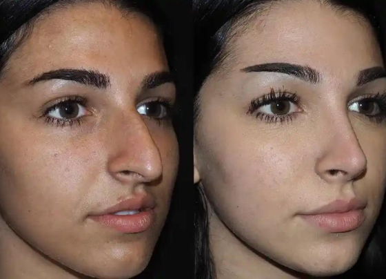 Correcting a Crooked Nose: Rhinoplasty Options and Techniques