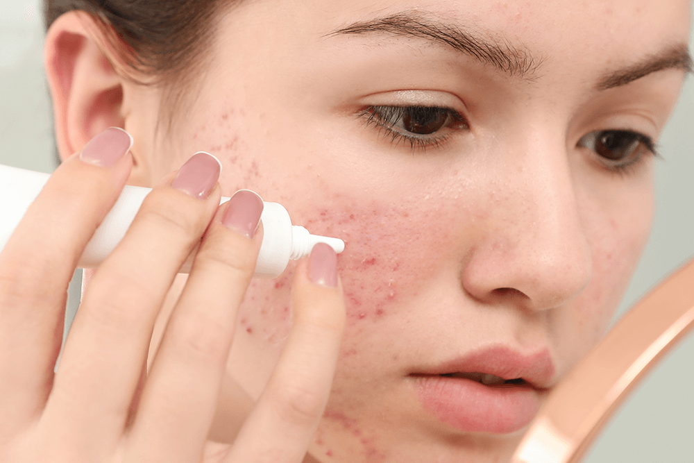 Tretinoin Treatment: What Dermatologists Want Patients to Know