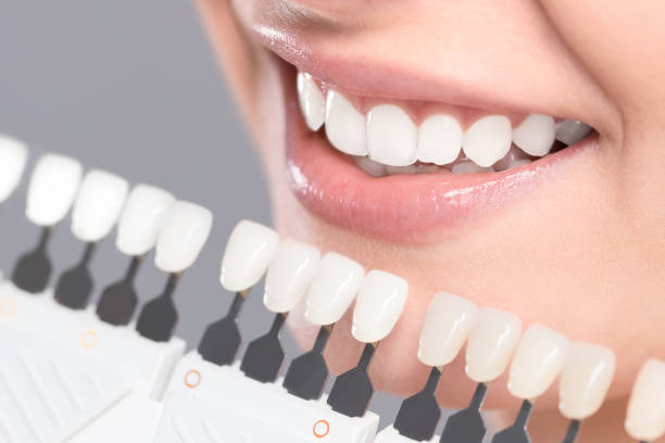 Discover Your Brightest Smile Yet: Advanced Teeth Whitening in Riyadh