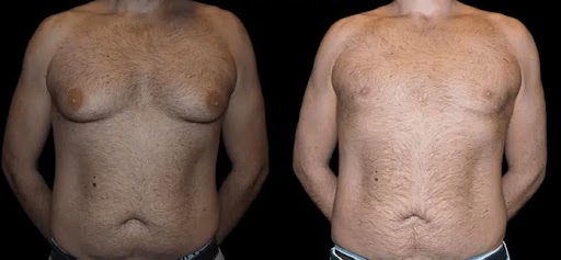 Male Breast Reduction Scars: What You Need to Know