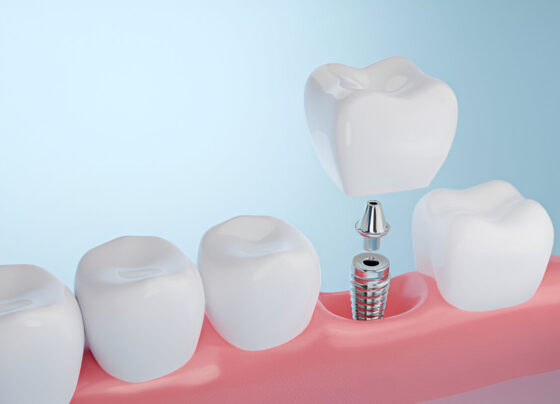 Dental Implants in Aberdeen