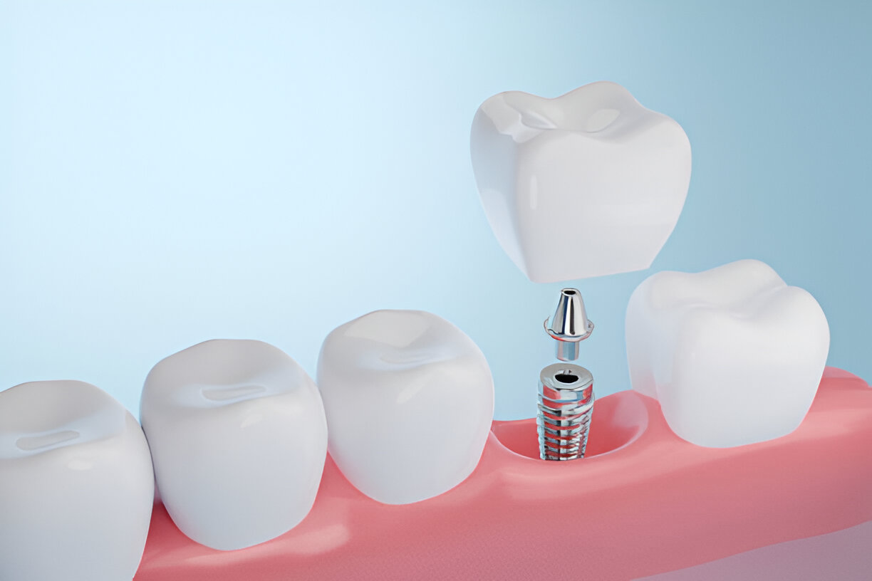 Dental Implants in Aberdeen: What You Need to Know